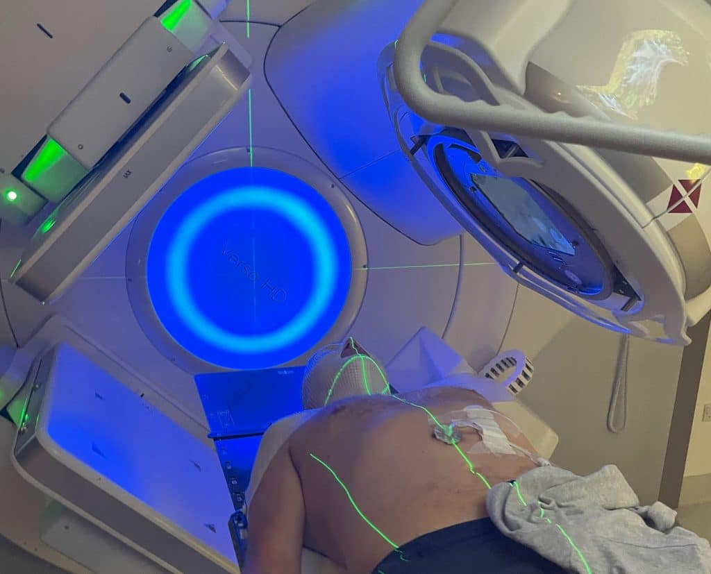 Patient in an ARC photon beam radiotherapy treatment