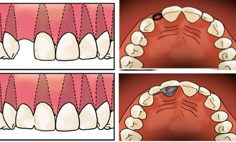 Top left and right shows a person missing on of their front teeth, bottom left and right show replacement of this missing tooth with a bridge which uses another tooth for support. This type of bridge is referred to as a resin retained bridge.