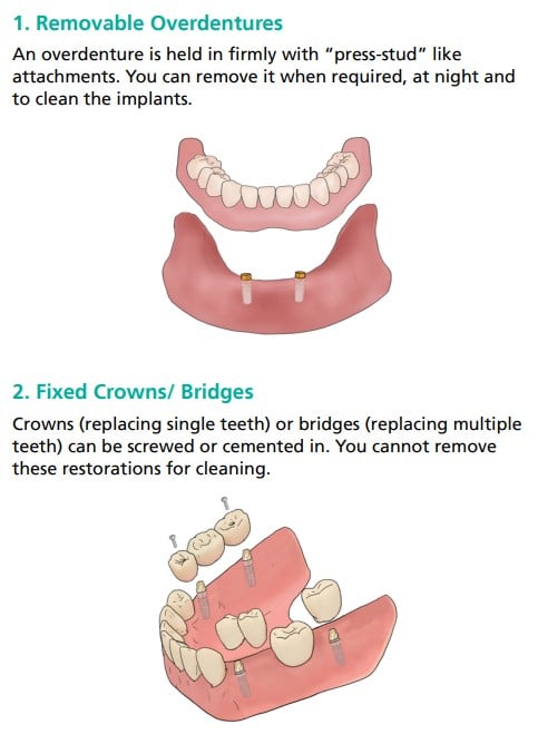 Shows tooth replacement with dentures and implants (1), and with crowns/bridges and implants (2)