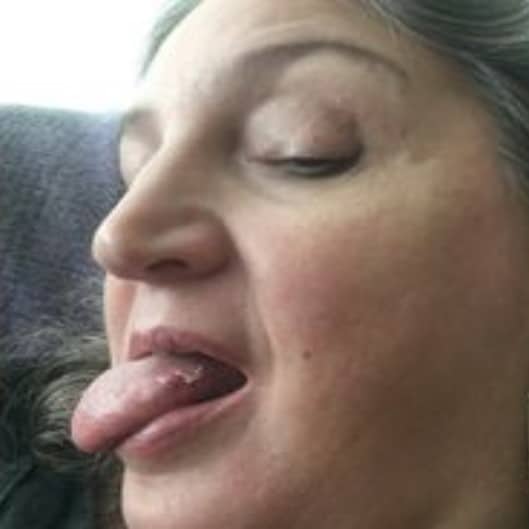 tongue cancer patient story